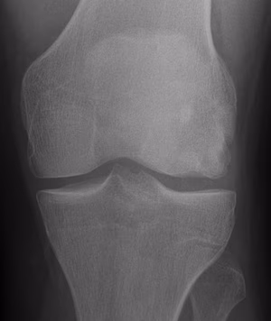 Knee OCD Lateral Femur AP
