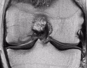 Knee OCD Mosaicplasty 9 months post