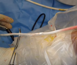 Lars ACL Pass Graft 2