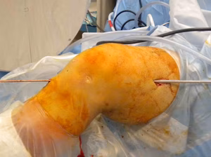 Lars ACL Guide Wire Clinical Photo