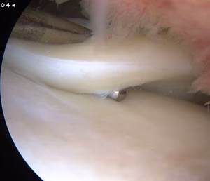 Lateral Meniscus Posterior Horn Tear Post ACL Rupture