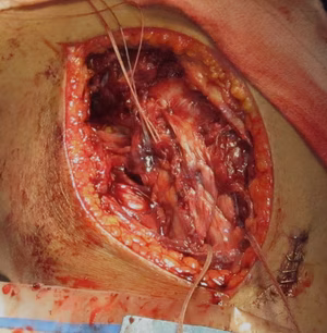 MCL Tibial Avulsion Double Row Repair