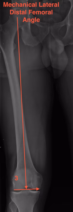 Mechanical Lateral Distal Femoral Angle