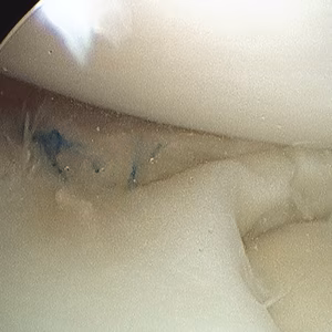 Mensical Repair all inside