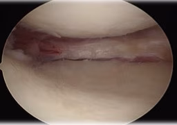 Meniscus Preparation 2