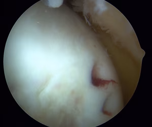 Mosaicplasty Harvest Site 2