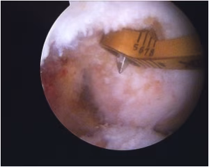 PCL Femur