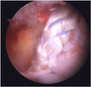 PCL Graft