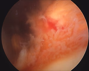 PVNS Knee