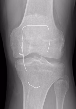 Patella Box Wire Broken AP