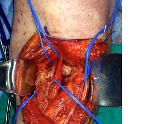 Posterior approach to knee