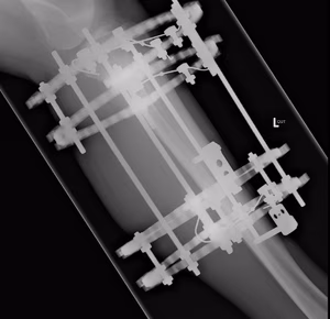Ilizarov Proximal Tibia Lateral
