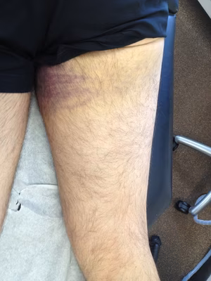 Proximal Hamstring Rupture Bruise