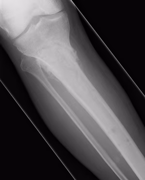 TSF Proximal Tibia Union AP