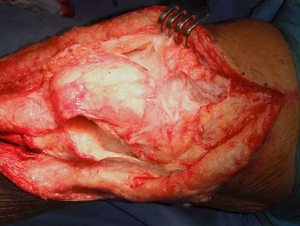 Quads Repair 1