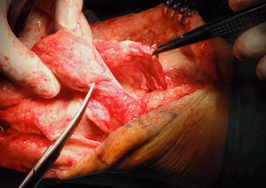 Quads Repair 2
