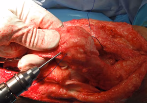 Quads Repair 6