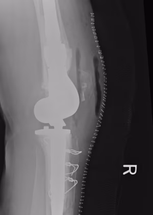 Revision TKR Tumour Implant