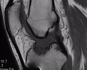 Revision ACL Ruptured Graft MRI BPTB Allograft