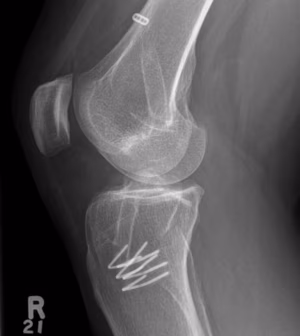 Revision ACL Lateral