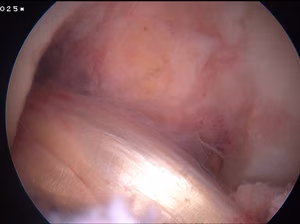 Revision ACL New Graft