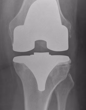 Revision TKR AORI Tibia Type 1 AP