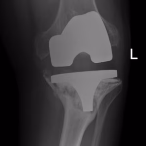 Revision TKR Tibial Lysis 2B