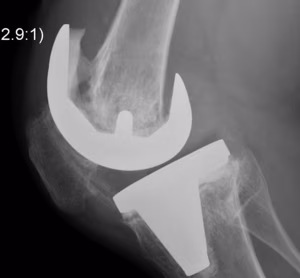 Revision TKR Deficient Femoral Metaphysis