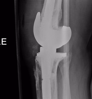 Revision TKR Hinged Lateral