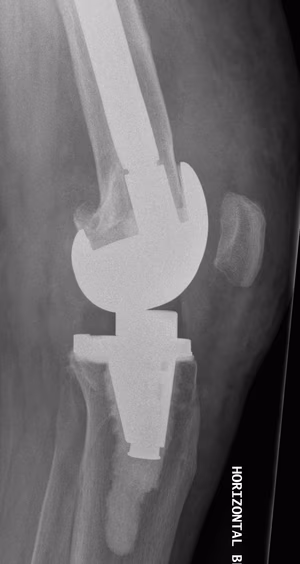 Revision TKR Quadriceps Repair