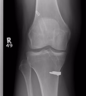 Revision ACL Pre AP Xray