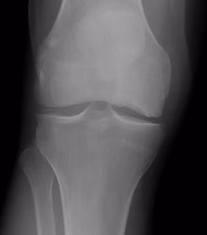 Spontaneous Osteonecrosis of the Knee