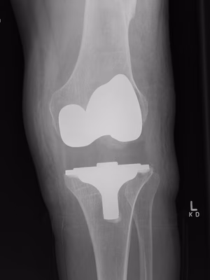 TKR Varus Instability Increase Poly Thickness
