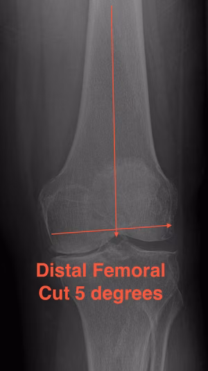 TKR Distal Femoral Valgus Cut