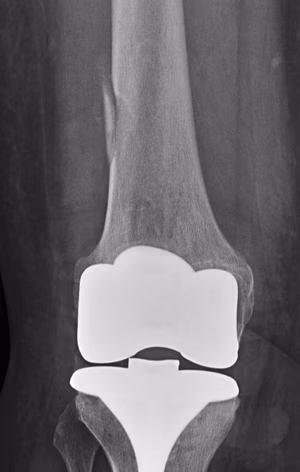 TKR Femoral Shaft Fracture IM Rod