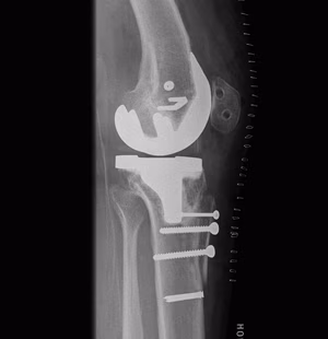 TKR Patella Maltracking TTT MPFL Lateral