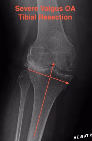 TKR Severe Valgus Tibial Resection Planning
