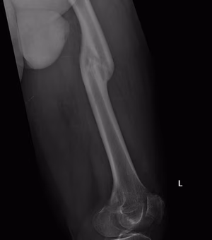 TKR Staged Osteotomy Preop 2