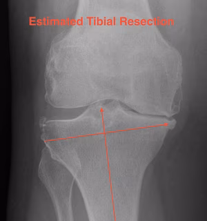 TKR Tibial Cut