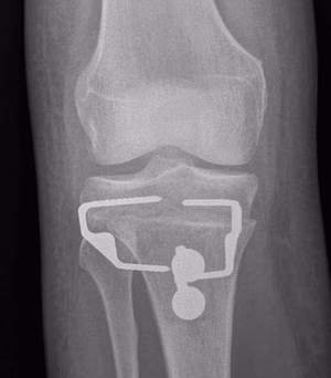 Tibial Derotation Osteotomy