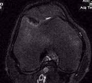 Trochlea OCD Post Patella Dislocation