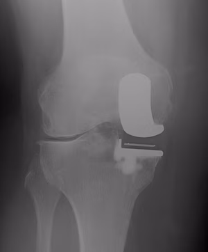 UKA Developing Lateral OA