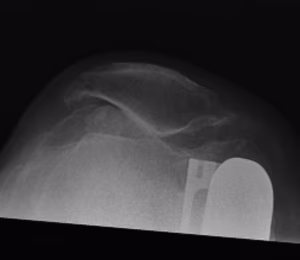 UKA developed PFJ OA