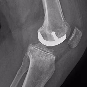 UKA Preop Revision Lateral