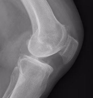 UKA Preop Lateral 1