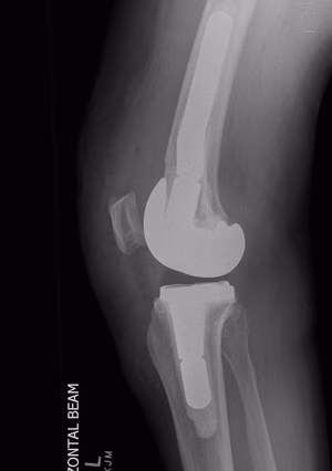 UKA Revision To TKR Lateral