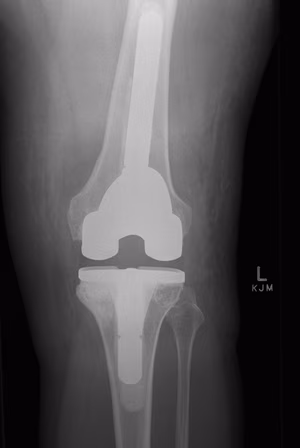 UKA Revision to Long Stem TKR