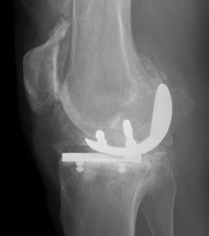 UKA Bearing Dislocation