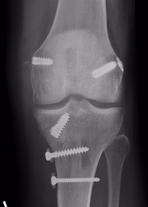 ACL MCL Recon