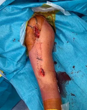MIPO incisions 1